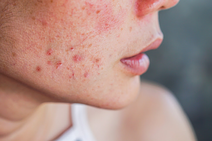 Benzoyl peroxide is effective in fighting acne causing bacteria